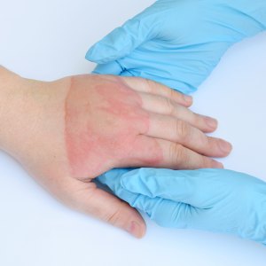Minor Burns Treatment in Bakersfield, CA